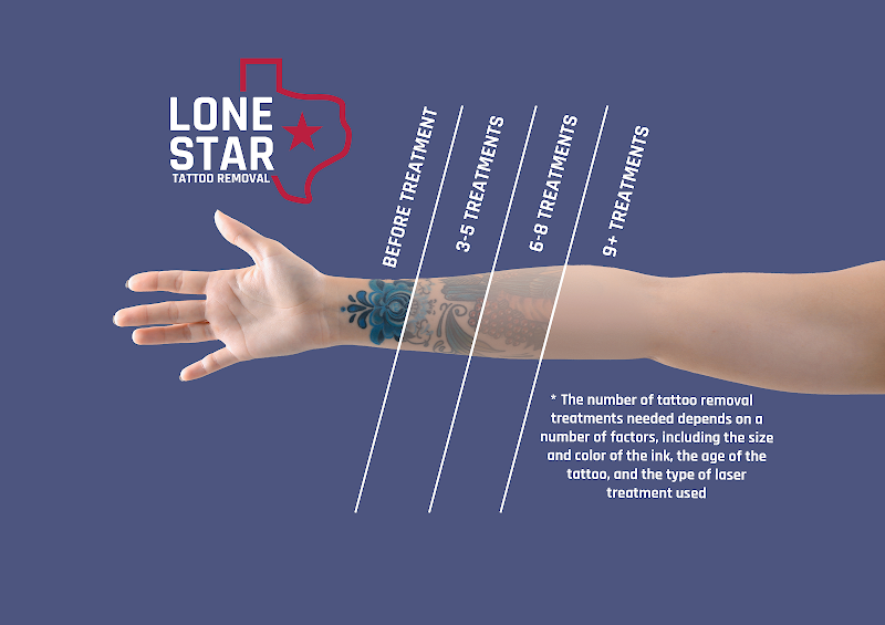 Lone Star Tattoo Removal