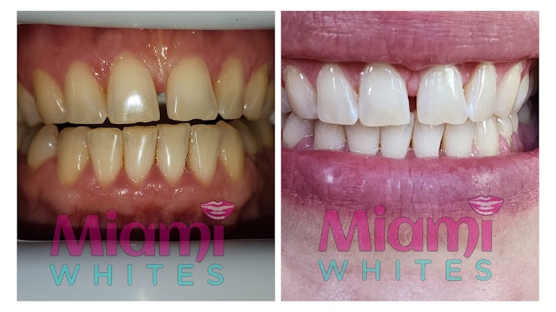 Miami Whites Teeth Whitening photo 1
