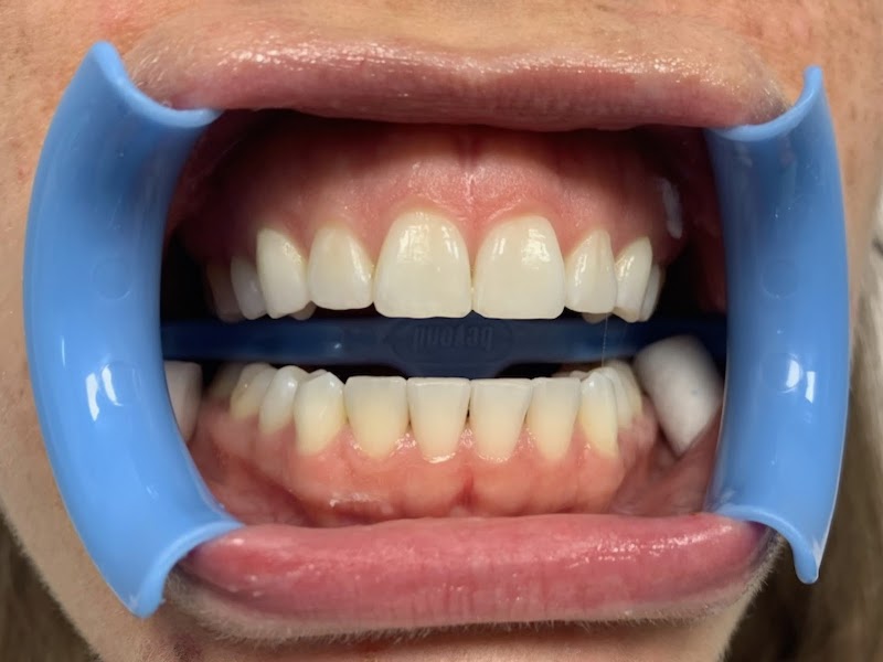 PHOTOWHITE Teeth photo 2