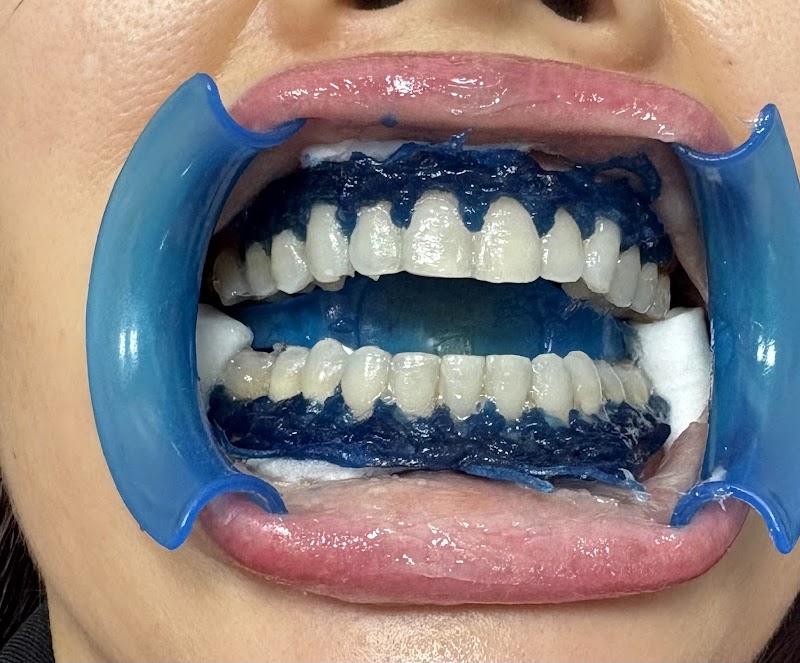 PHOTOWHITE Teeth photo 3