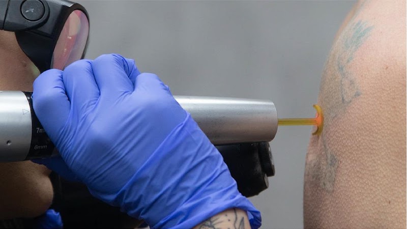 Removery Tattoo Removal & Fading photo 2