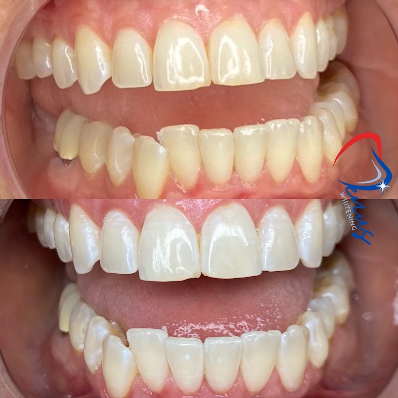Venus Teeth Whitening photo 1