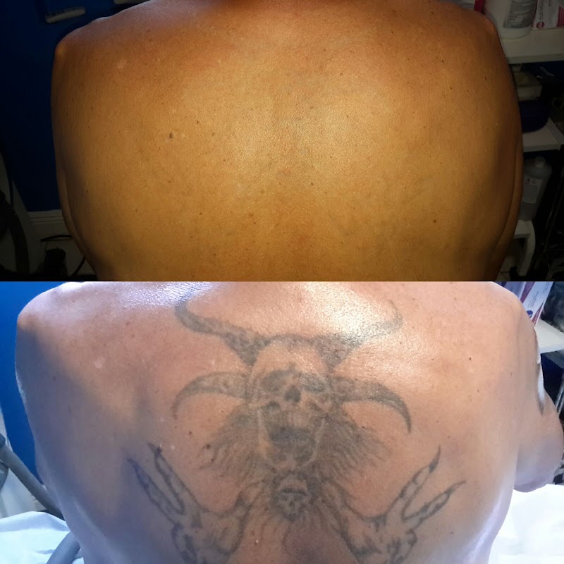 Winter Park Tattoo Removal photo 1