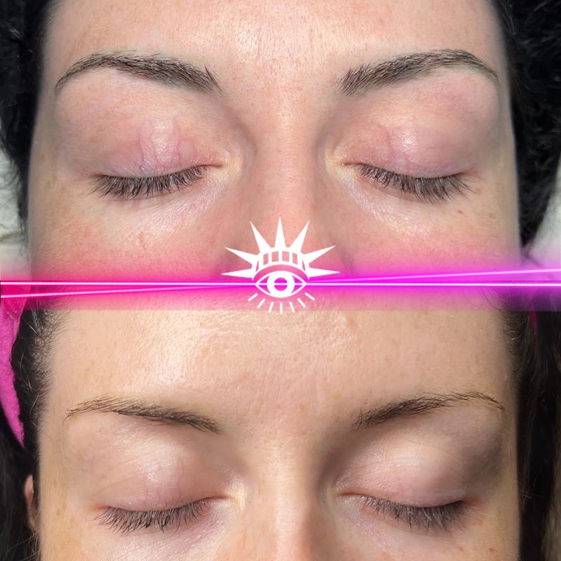 WOW LASER NYC Tattoo removal in New York photo 2